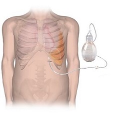 Catéter colocación